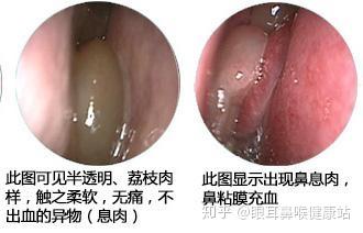 让鼻息肉不再复发的关键