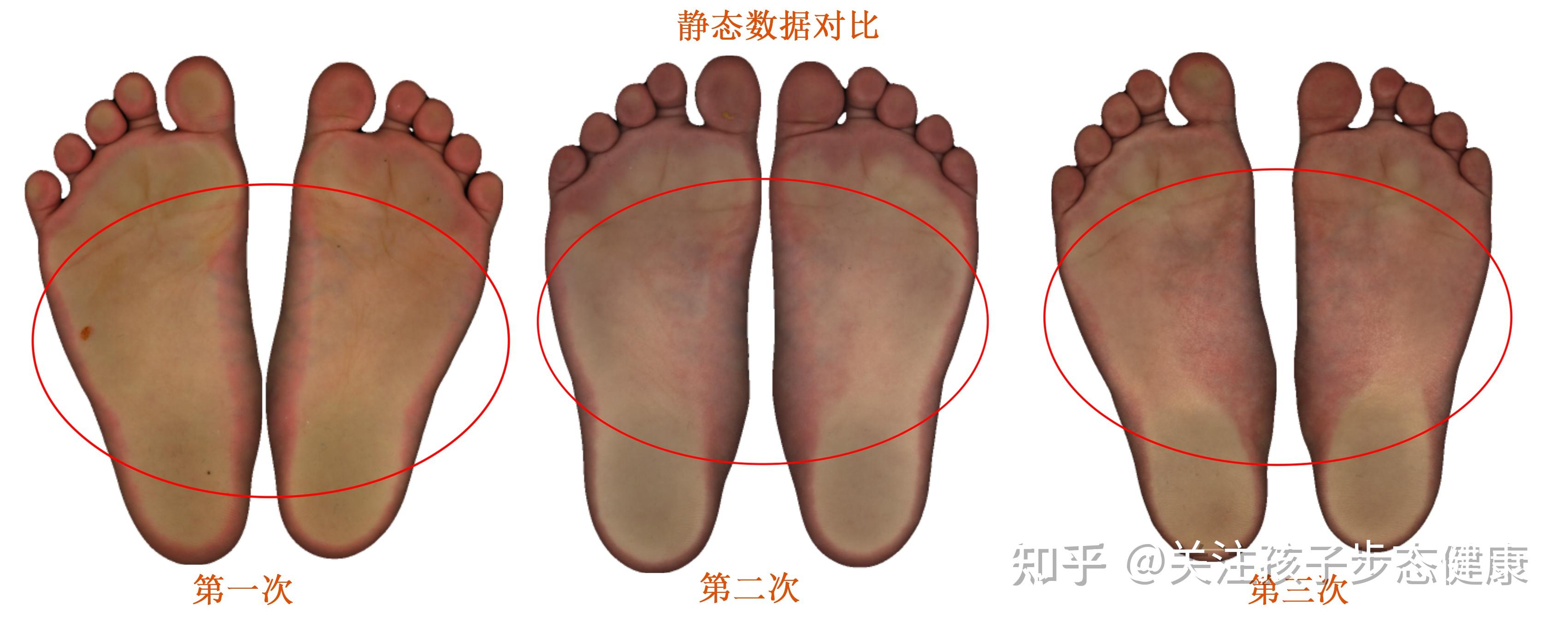 科案例｜儿童步态矫正展示——扁平足+失衡性步态 - 知乎