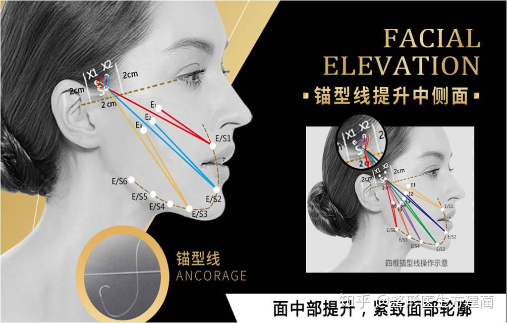 针对面部提升常用的悦升线做法