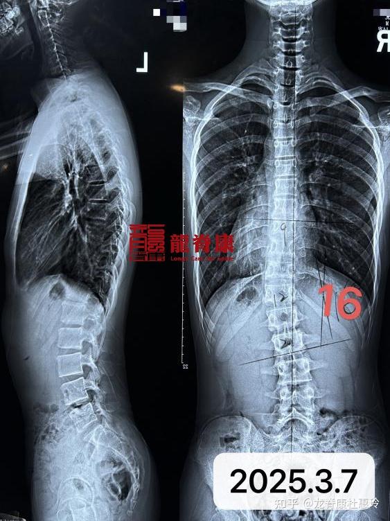 14岁侧弯男孩,坚持佩戴支具和训练不到1个月,剃刀背7°减至2°! - 知乎