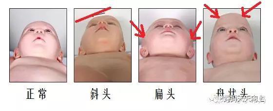塑造婴儿完美头型全指南（美国儿科学会教你预防和治疗扁头偏头） - 知乎