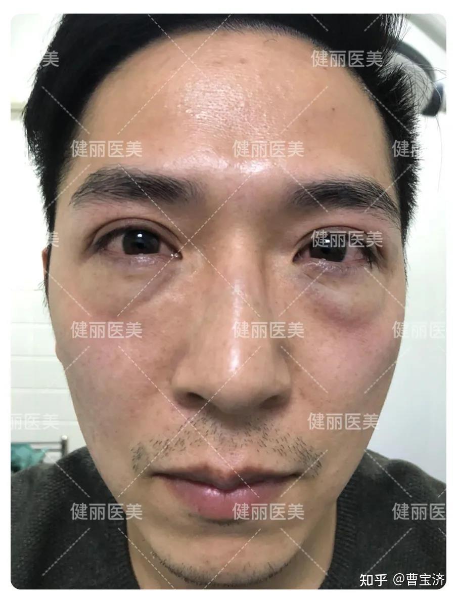 去眼袋竟有小妙招看这3位男士怎么做