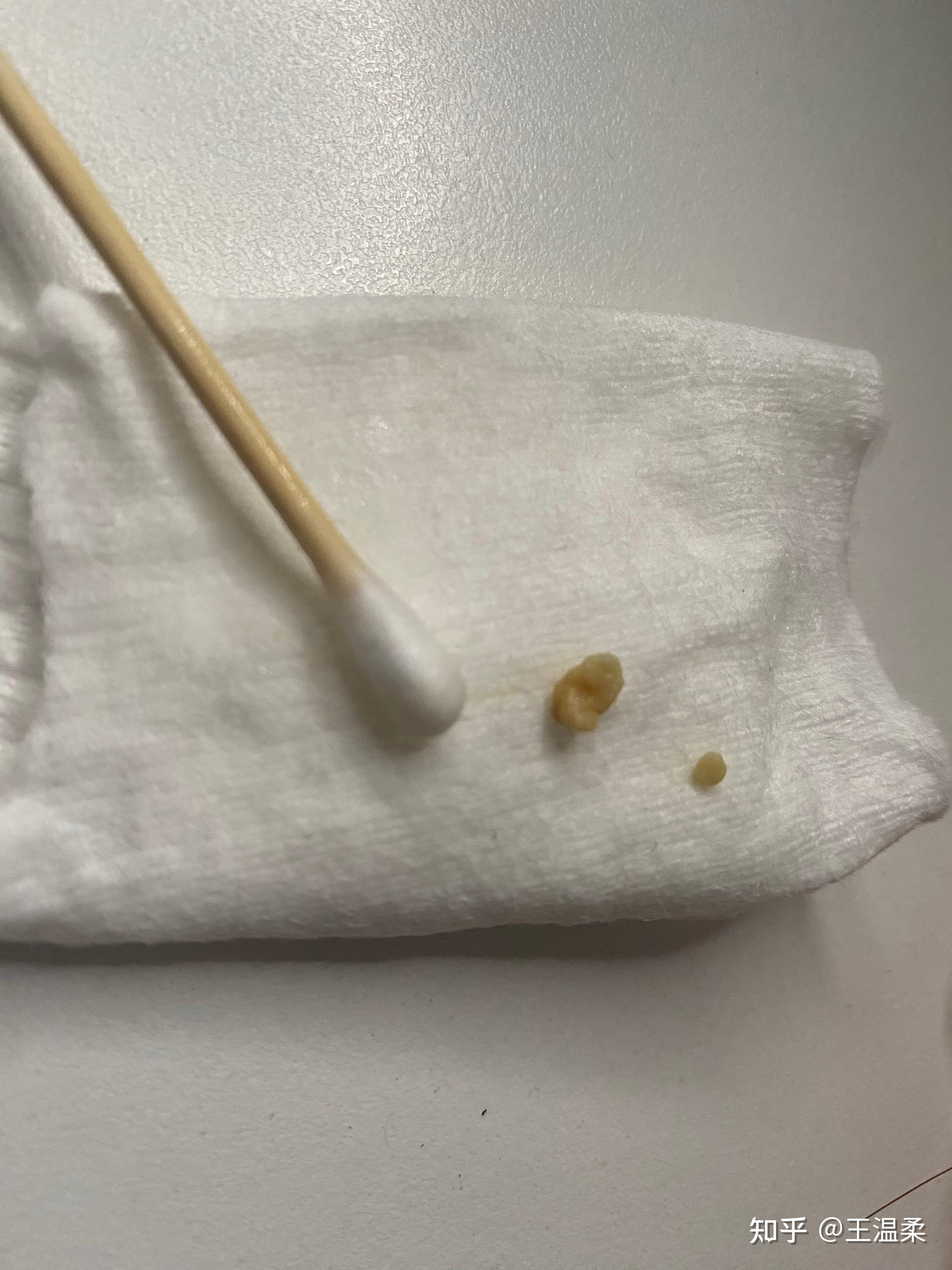 扁桃体结石如果不人为清除它自己会脱落吗