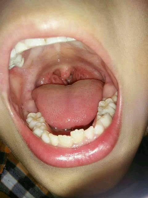 腺样体肥大中医讲要调护脾胃