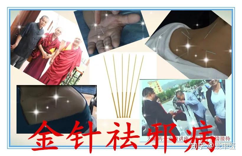 针灸培训 张氏金针,独门针灸绝技爱中医