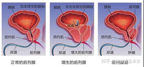 致使雄激素对雌激素的抑制作用减弱,雌激素水平相对上升,刺激了前列腺