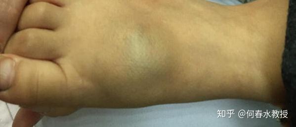 好可怕别再把这种病当成血管瘤
