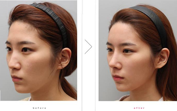 自体脂肪填充和SVF-GEL脂肪胶有什么区别？ - 知乎