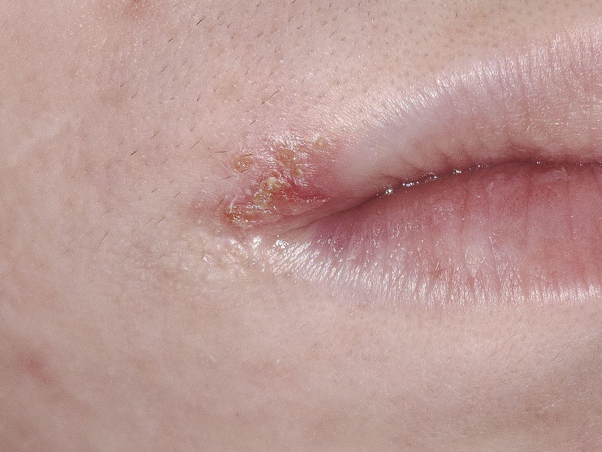 嘴角起泡如何处理可以最短时间痊愈?