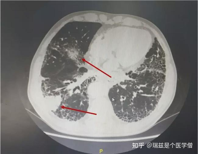 CT报告怎么看?3分钟教你读懂! - 知乎