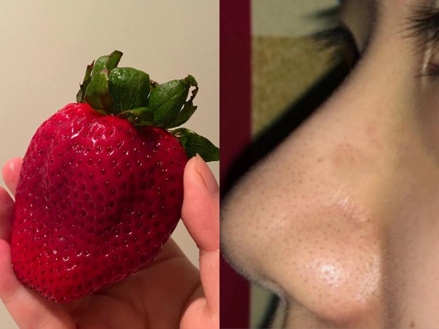 我的鼻子为什么是这样这是酒糟鼻草莓鼻吗