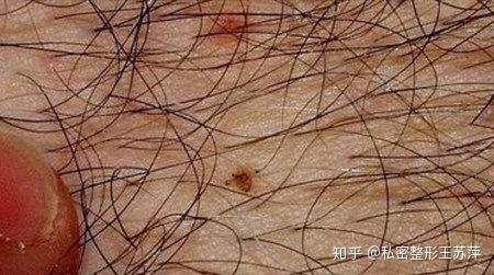 外阴有大颗的痘痘疙瘩,请问是因为上火吗? - 知乎