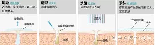 什么是针清祛痘？ - 知乎