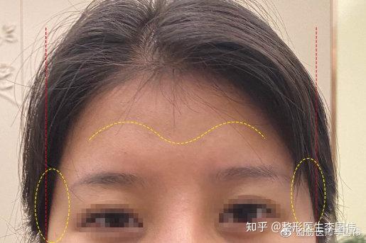 额头凹陷区分改善涉及的美学填充物如何选择