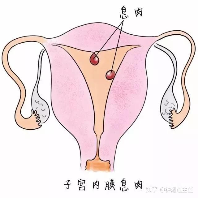 2 人赞同了该文章输卵管碘油造影专家钟湘莲主任