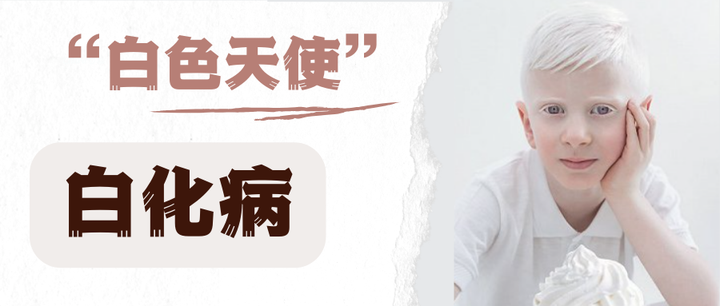 【白化病】全身皮肤及毛发色素减退，白化病可能是罪魁祸首！ 知乎 
