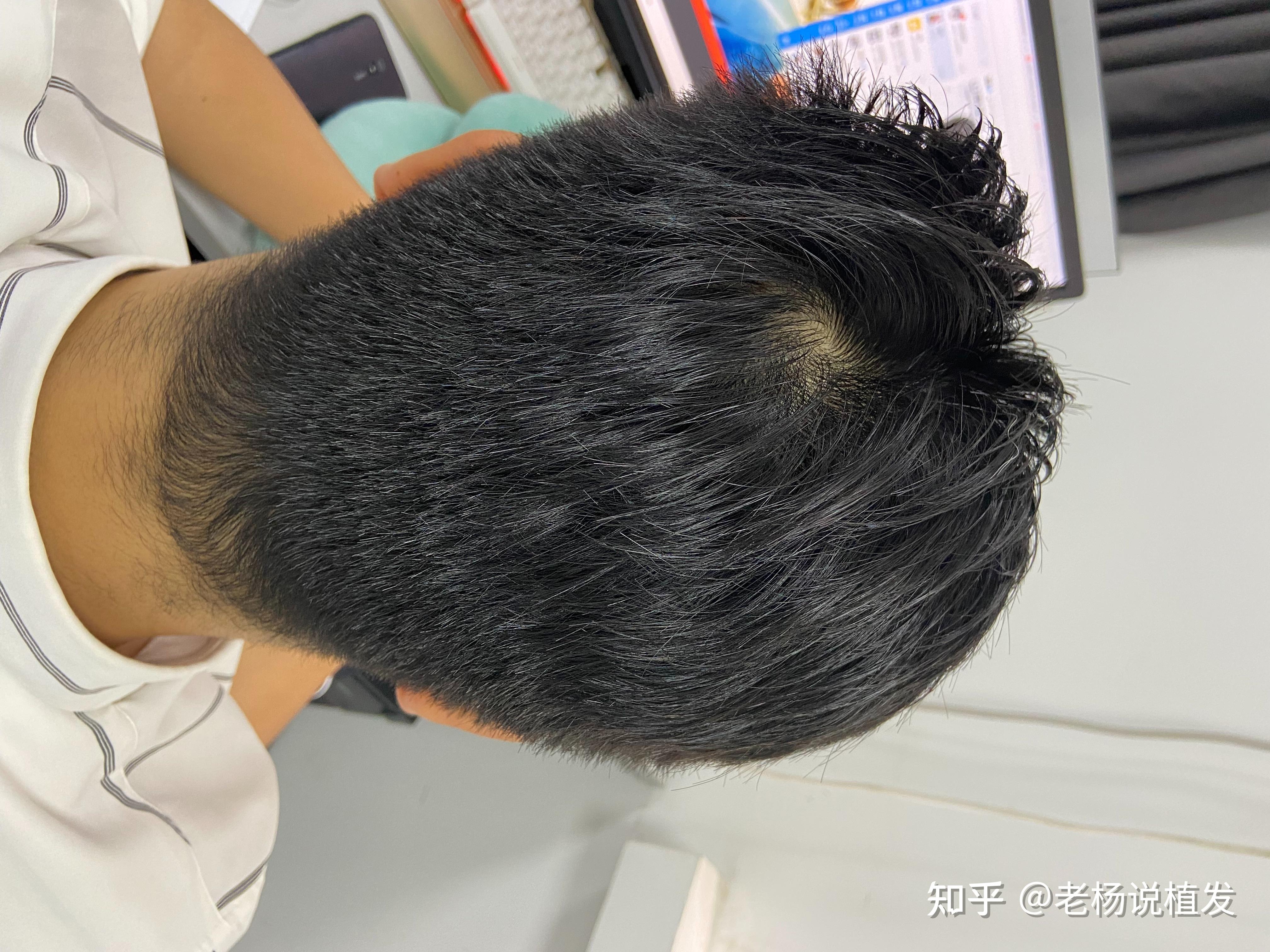 头发正常嘛，头顶秃不秃，留长发能盖住嘛?短发照片都是从六月开始使用米诺微针，长发的时候是去年的情况。? - 知乎