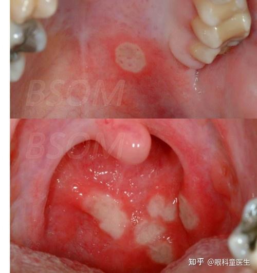 白塞氏是一种什么病图片