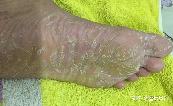 脚老是蜕皮怎么办,经常脱皮太难看了,如何应对?