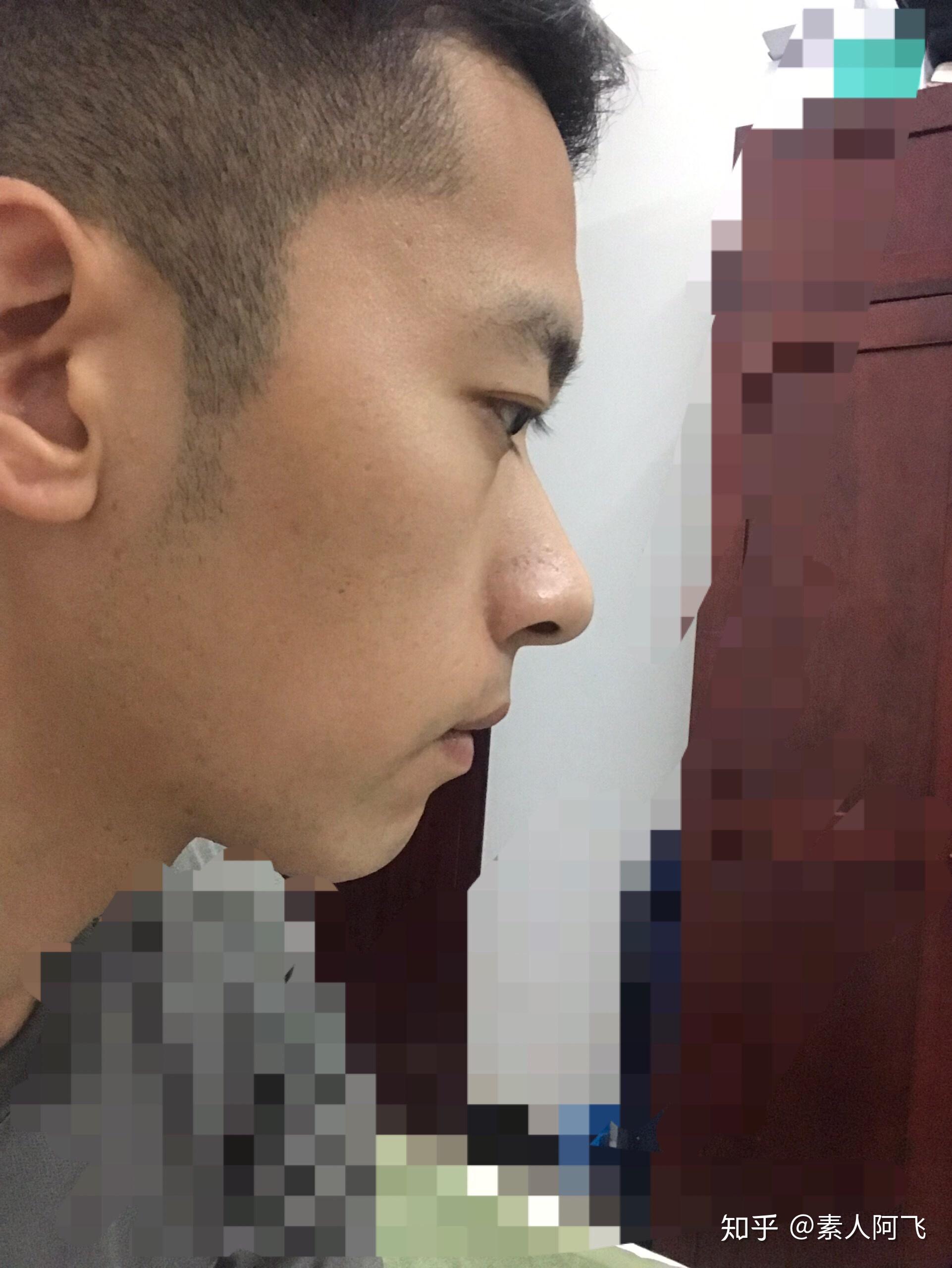 鼻子高但是山根低是什么样? - 知乎