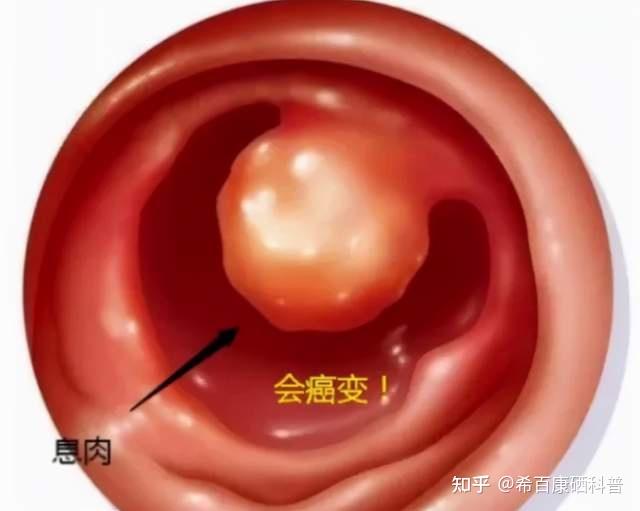 我女朋友说她是处女但是得了宫颈息肉怎么解释
