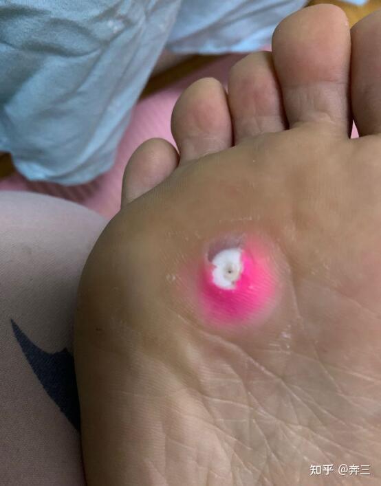 修鸡眼一般要多少钱? - 知乎