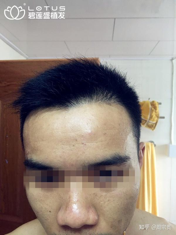 从额角开始的脱发,为什么那么难发现? - 知乎