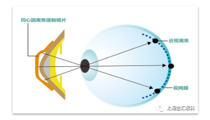 安視美國內唯一高透氧近視控制離焦軟鏡登陸志匯眼科