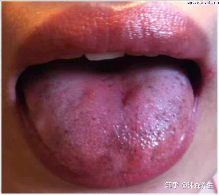 对于有心脑血管疾病的人来说,舌头或者嘴唇呈现暗紫色或有淤斑,多数是