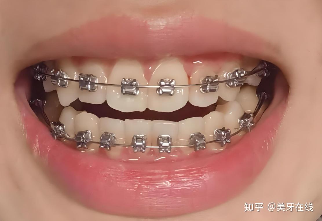 关注问题 67 写回答 登录/注册 牙齿矫正方法 矫正牙齿费用?