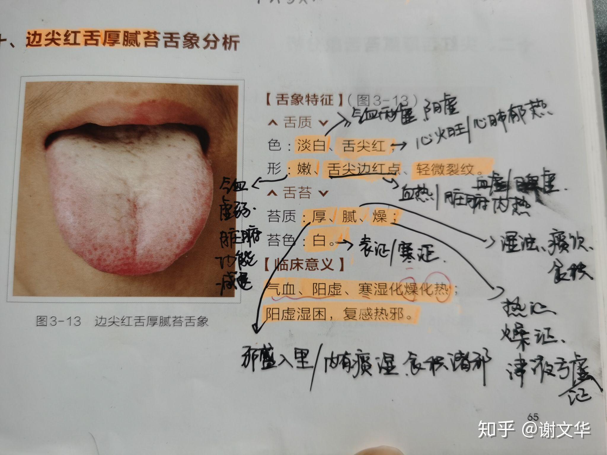 十、边尖红舌厚腻苔舌象 - 知乎