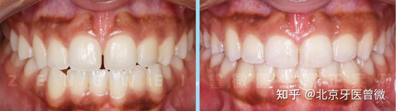 对刃关系科普正常的咬合关系是上前牙盖过下前牙三分之一左右,而对刃