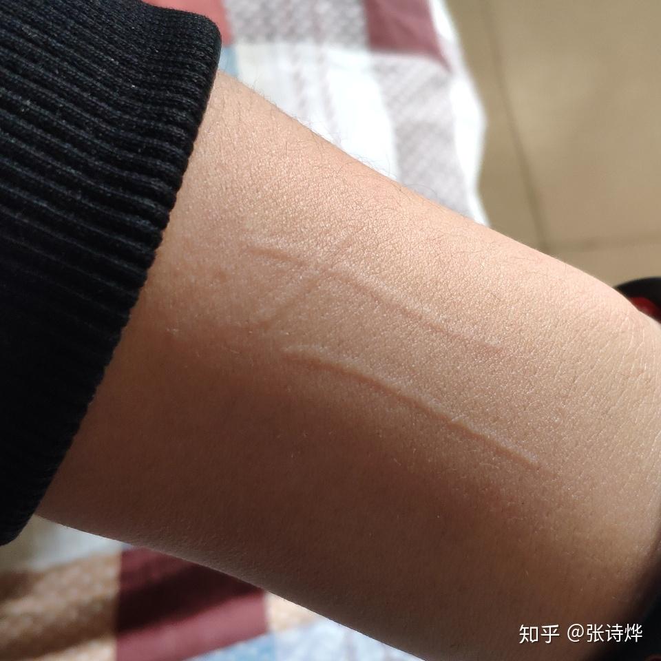 到目前为止有慢性荨麻疹人工划痕症的知友治愈的吗