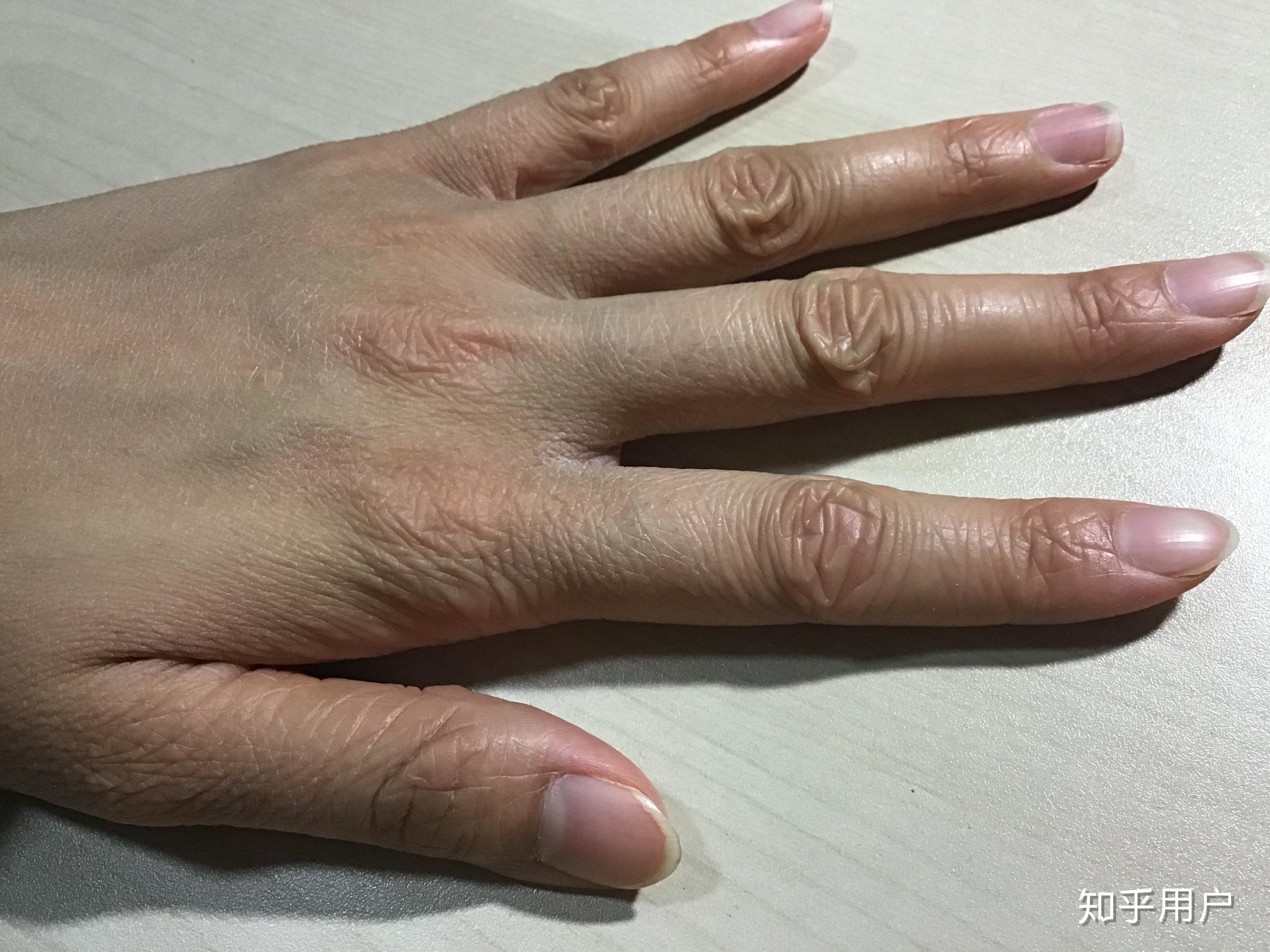 请问鱼鳞病患者的手都是老人手吗