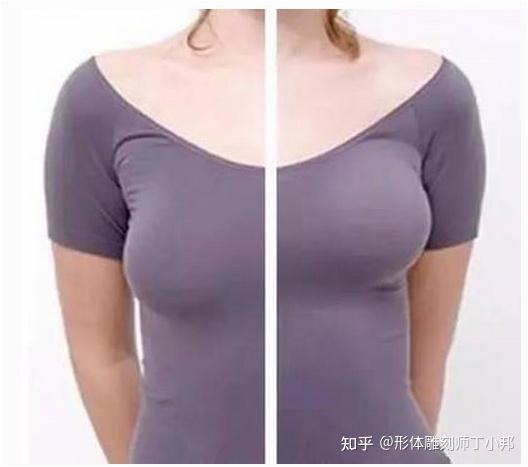 假体隆胸能改善乳房下垂吗？ 知乎