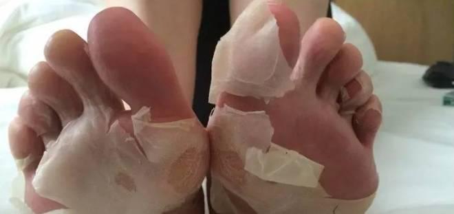 这才是真正的抠脚大汉一年抠下的脚皮可以绕地球好几圈