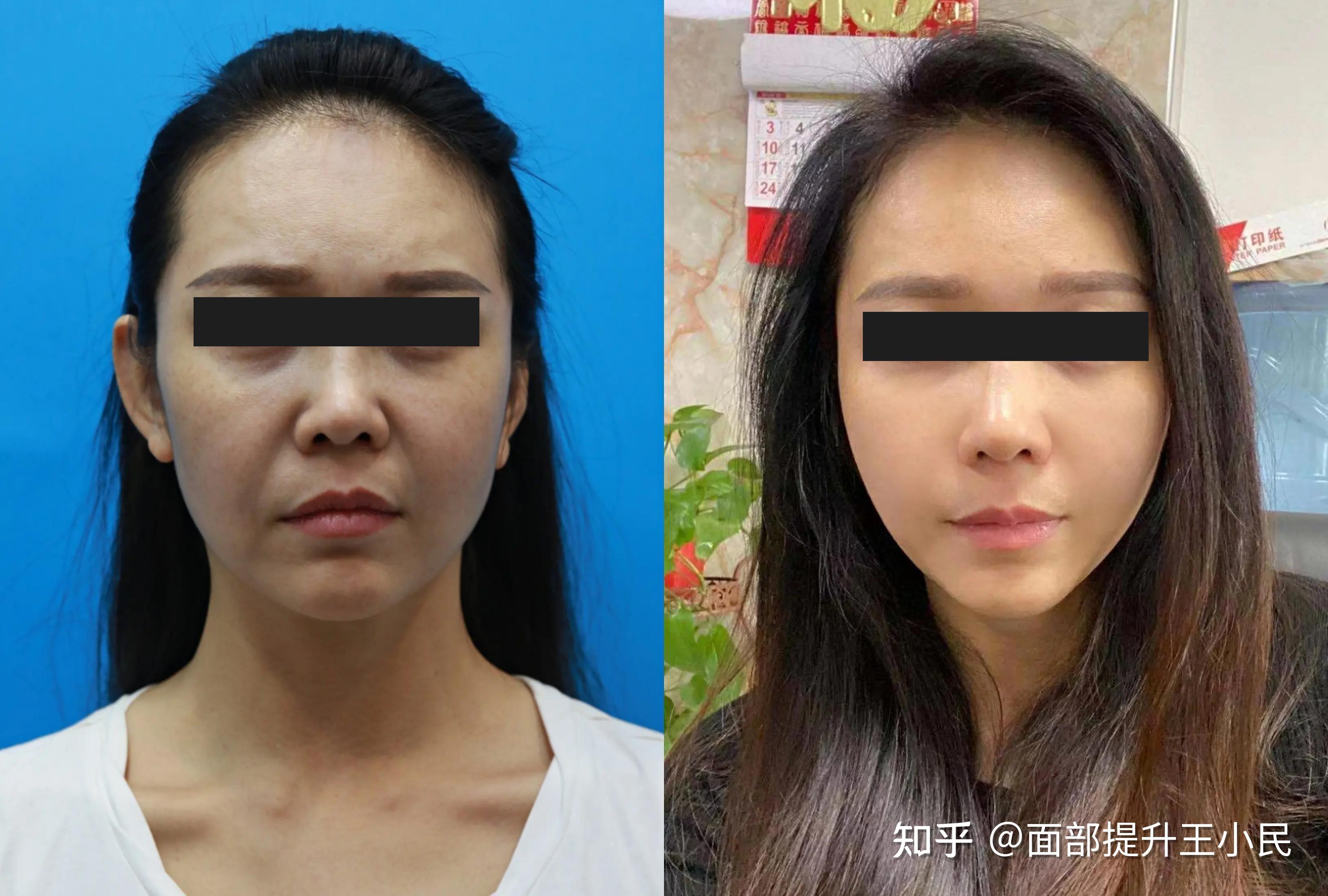 紧致抗衰45岁做拉皮手术能维持多久