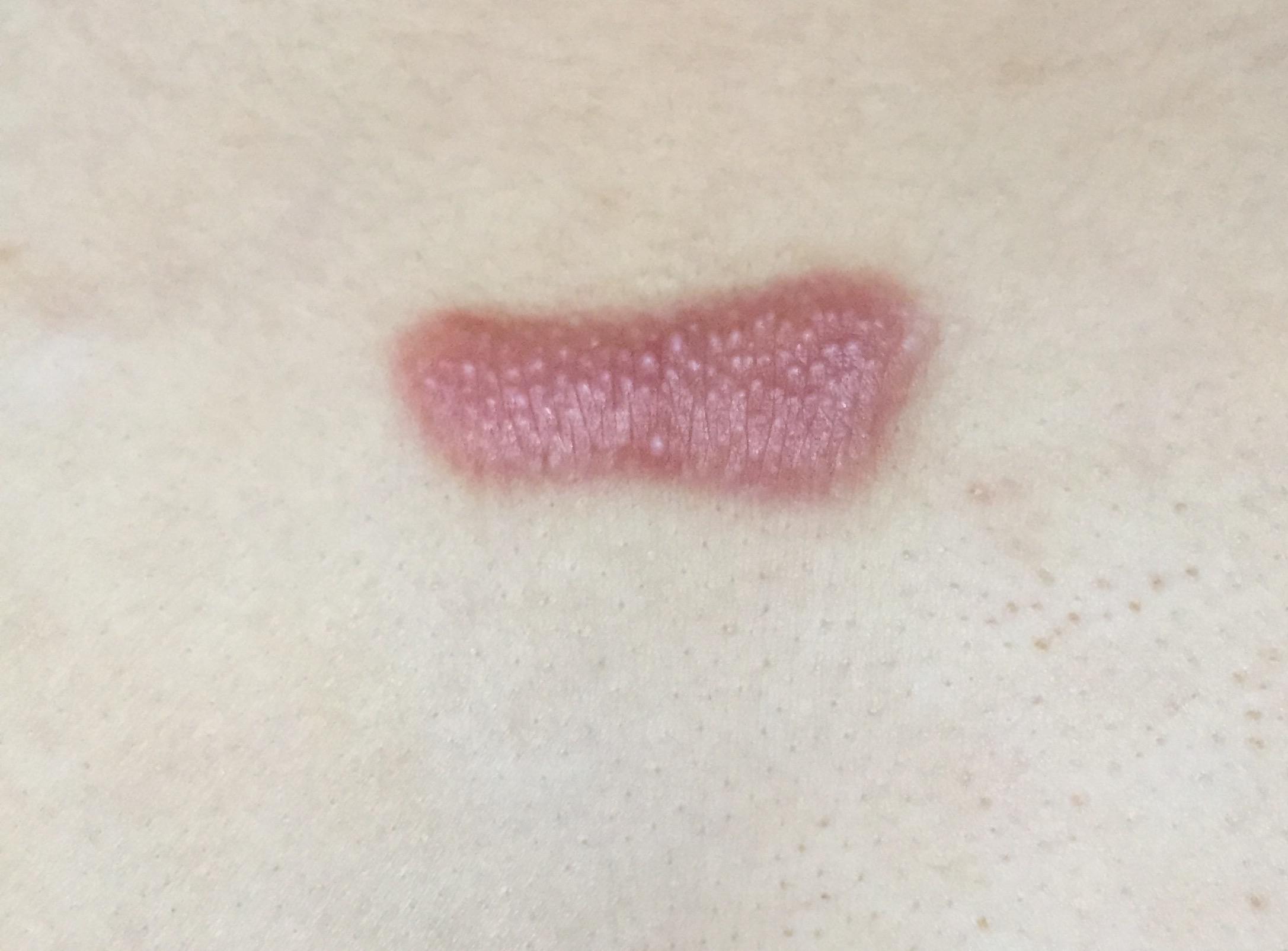 疤痕疙瘩到底怎么治?能不能治好?自己胸前长