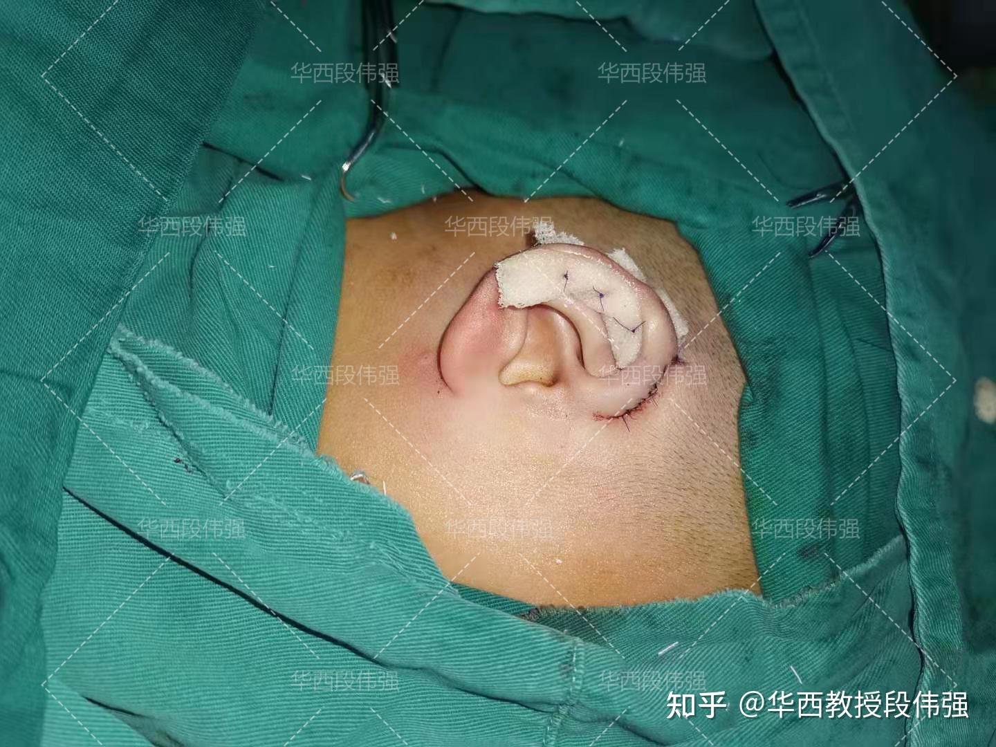 隐耳合并杯状耳案例