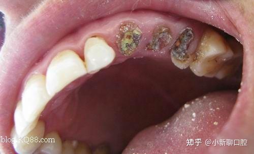 牙齿残根不拔掉?有哪些危害? - 知乎