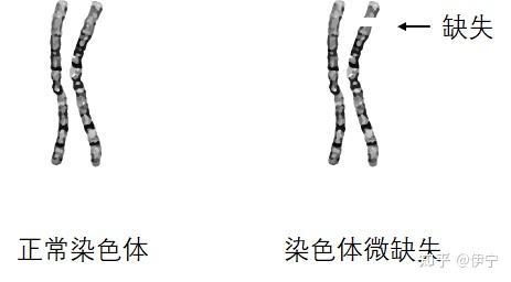 染色体微缺失患者,能生出健康的宝宝吗?