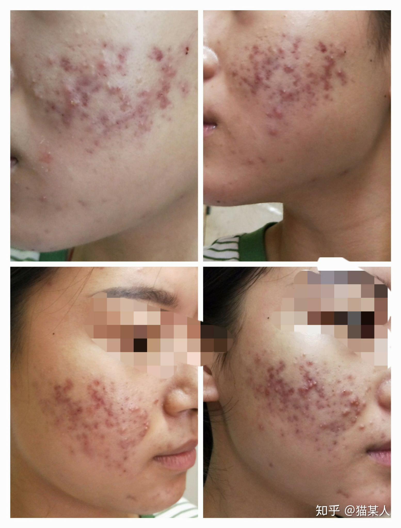 记录治疗痘痘的过程