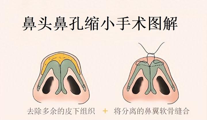 鼻孔大怎么矫正缩小后看起来更自然 - 知乎