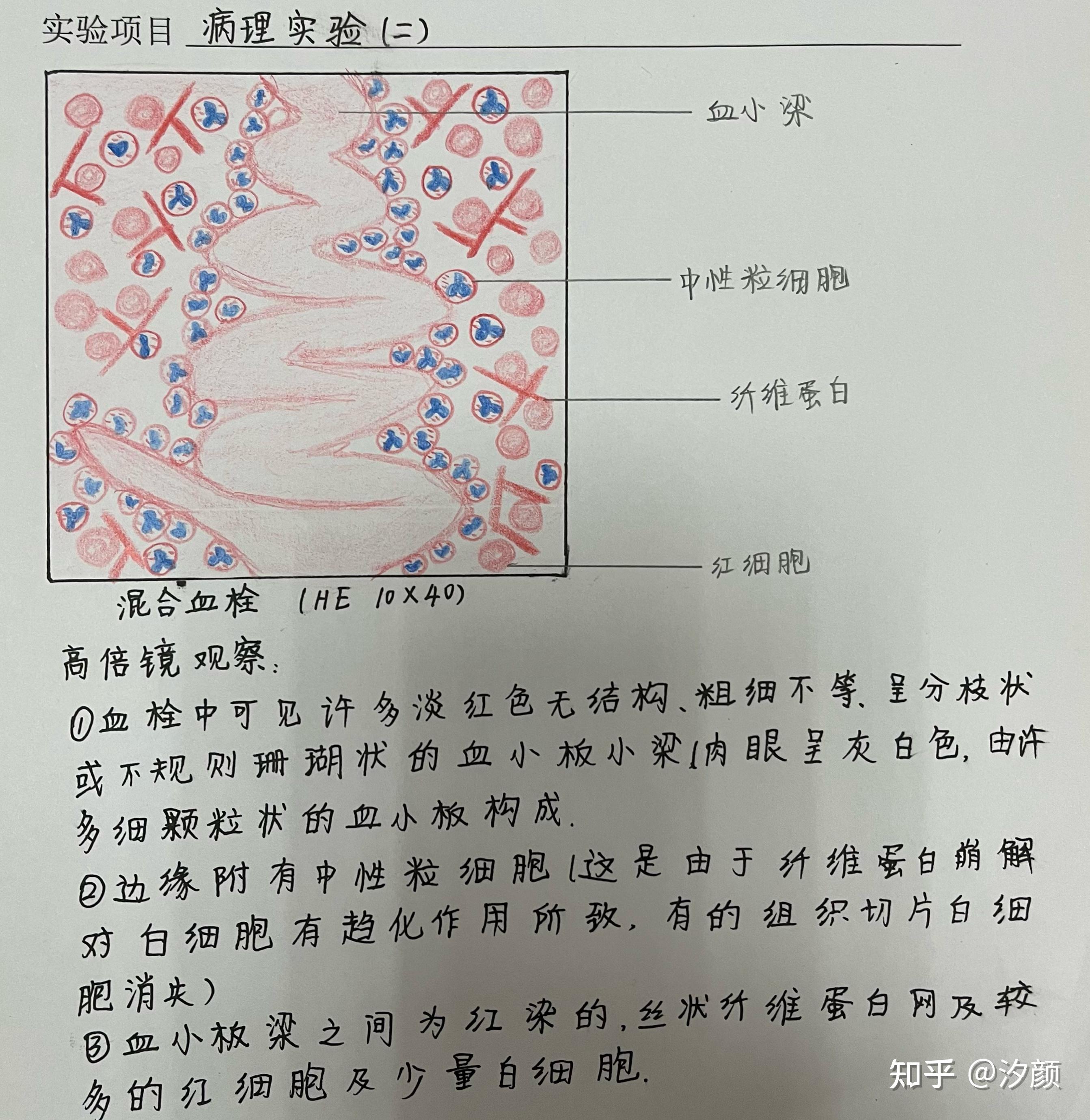 急性蜂窝织性阑尾炎5.鳞状细胞癌6.风湿小体7.灰色肝样期8.