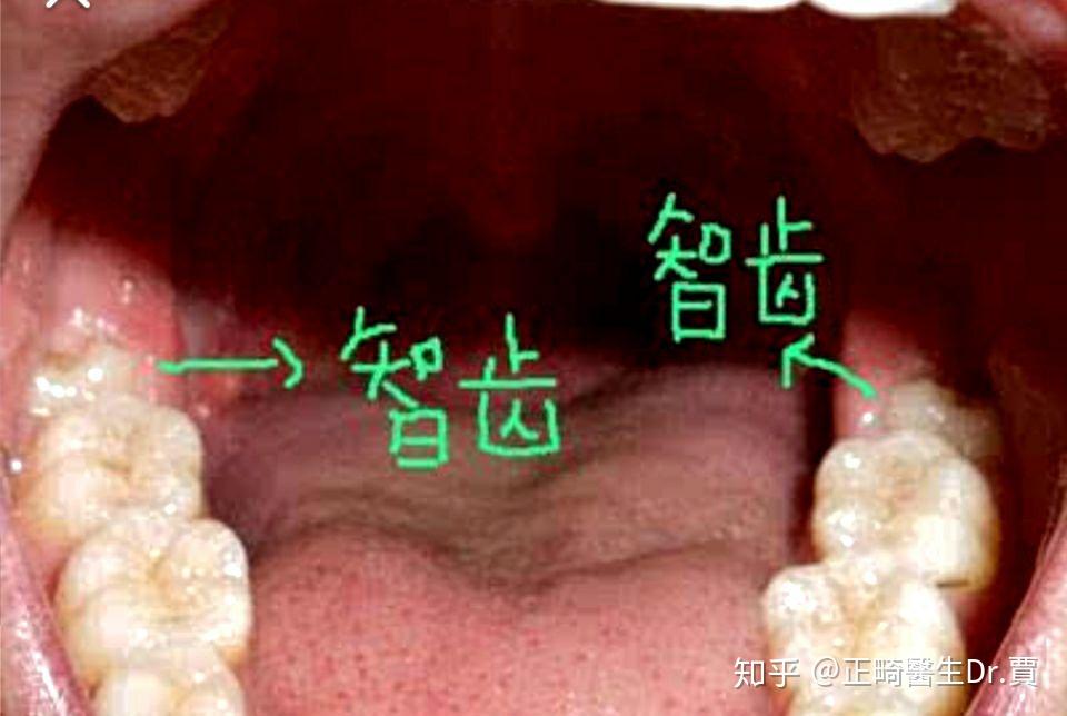 很容易向后掉到智齿盲袋里头