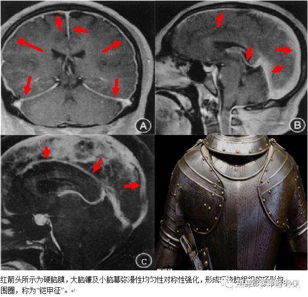 值得收藏的顱腦21種影像徵像