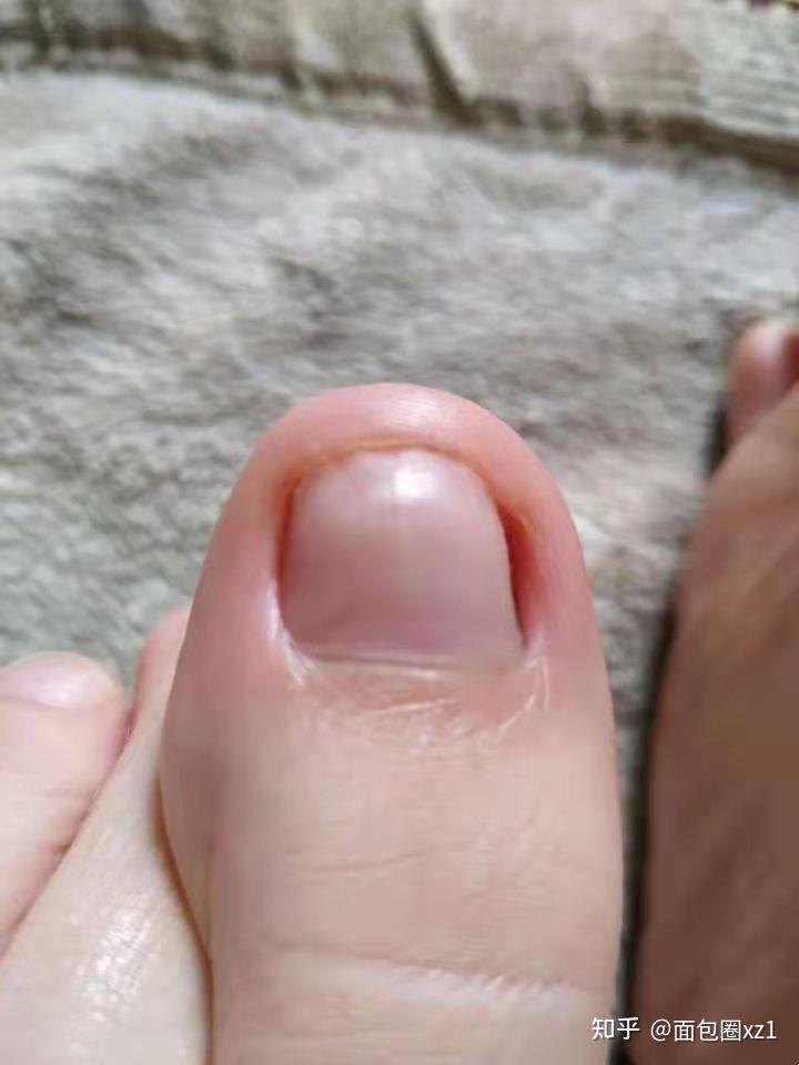 灰指甲初期症状 最初图片
