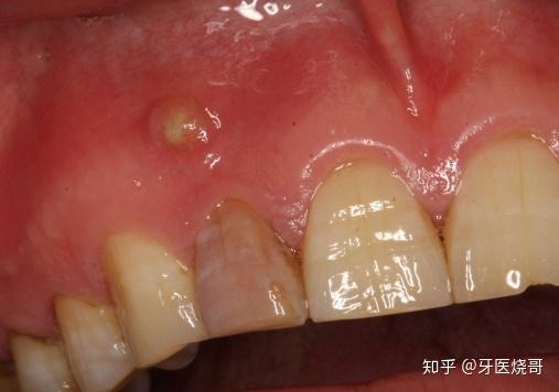 牙龈上长了一个脓包怎么办? - 知乎