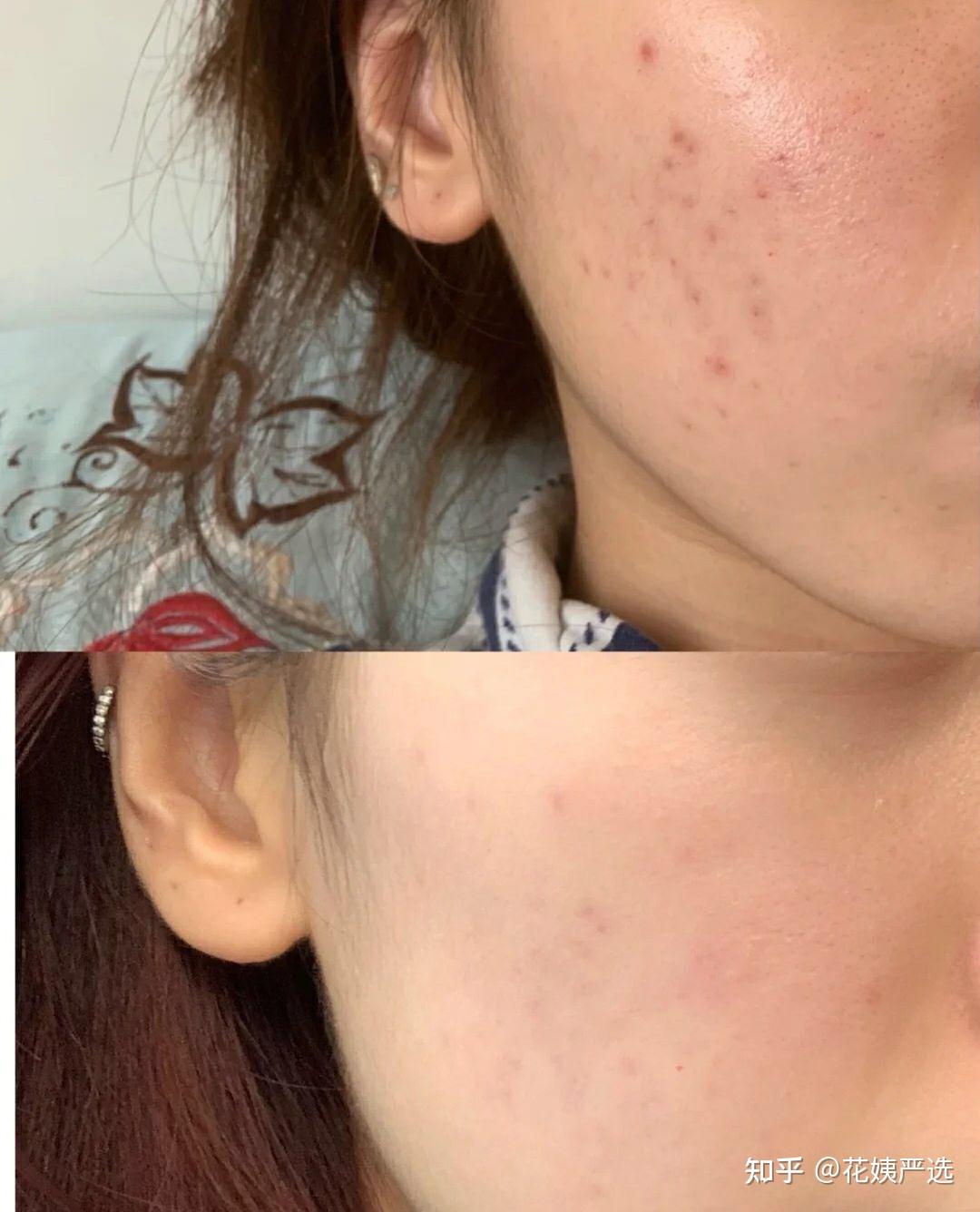 刷酸没有效果你是不是搞错方法了