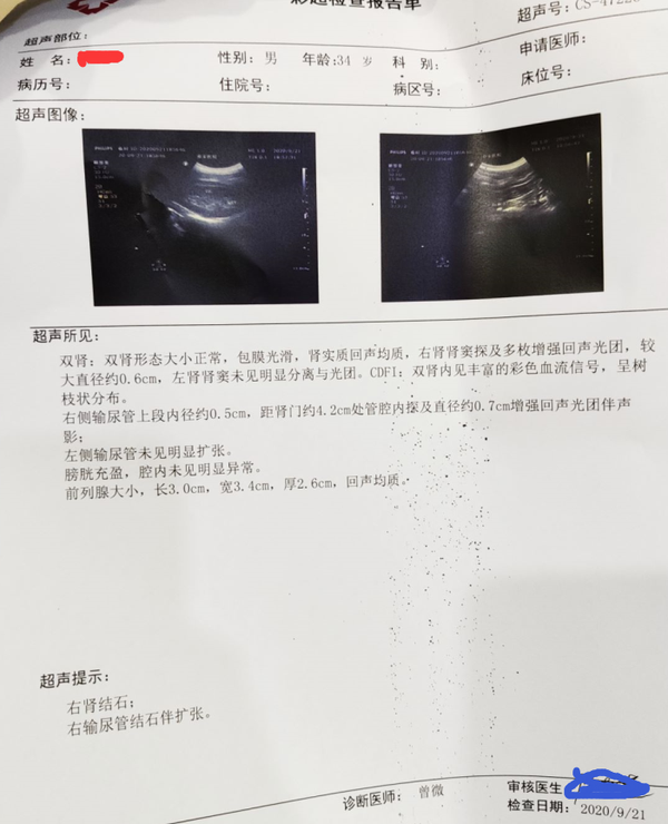 7mm肾结石一颗排出分享 知乎